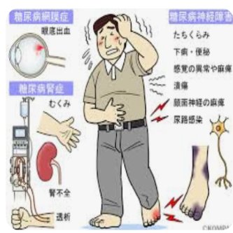 【発表】糖尿病が強く疑われる人、全国で1100万人…8年で100万人増 厚生労働省