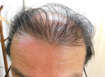 【速報】髪の毛作る「第3の細胞」発見　新たな脱毛症治療に、理研や国内新興